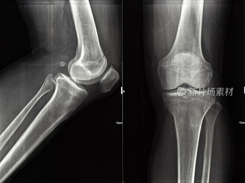 人体腿和膝盖x射线图像