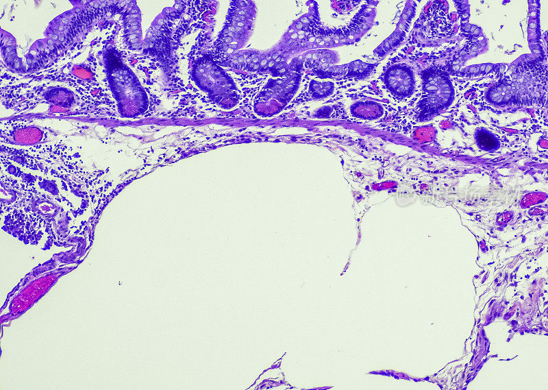 积气囊状的intestinalis。摘要肠囊病(PCI)是一种罕见的疾病，其特征是肠壁存在含有氮、氢和二氧化碳的气态囊肿，可能是医源性或与之相关