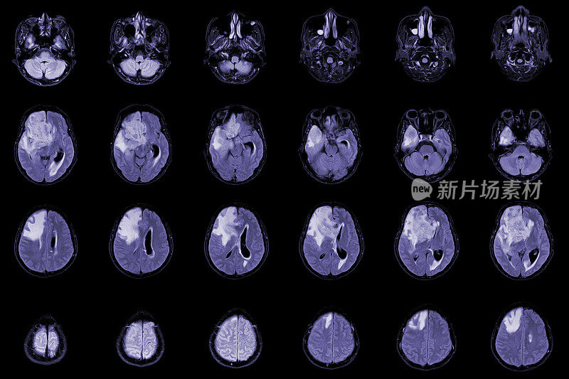 MRI脑轴位图用于评价脑肿瘤。恶性胶质瘤，脑转移等密度肿块，边缘不清，右额叶周围水肿。
