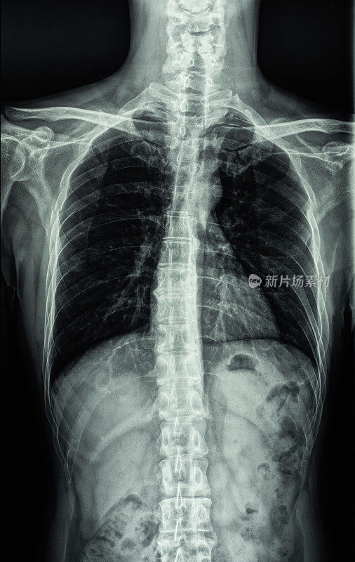 人体胸部和脊柱x射线图像