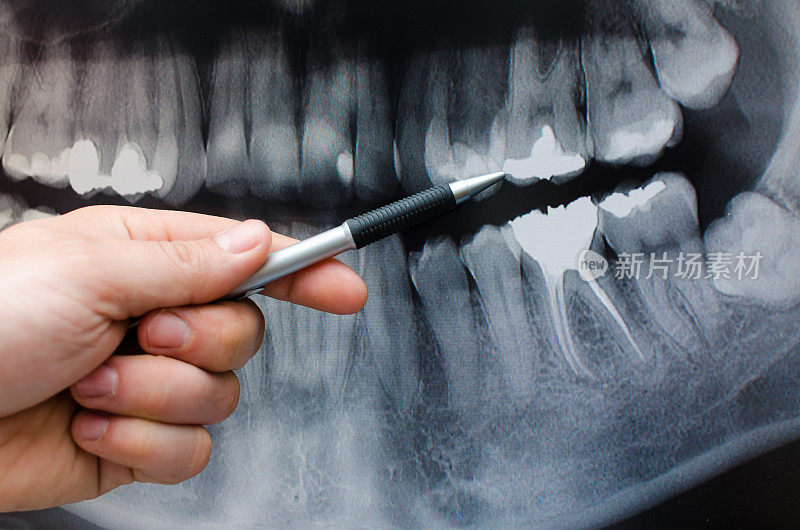 牙科医生在牙科x光图像上显示了一些东西