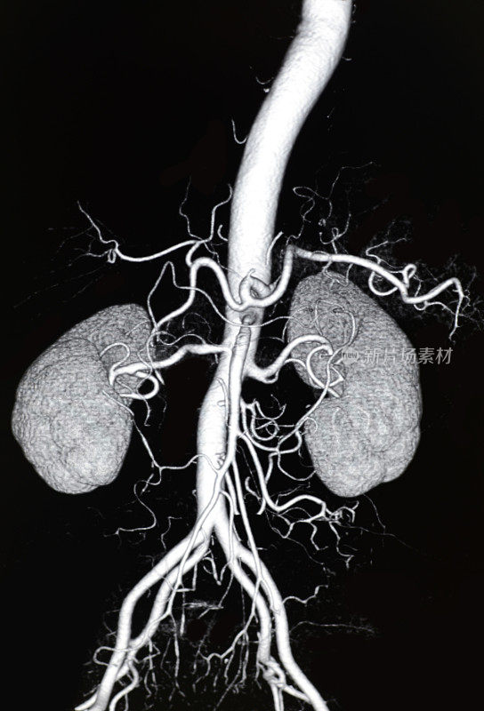 主动脉和肾动脉CT容积显示
