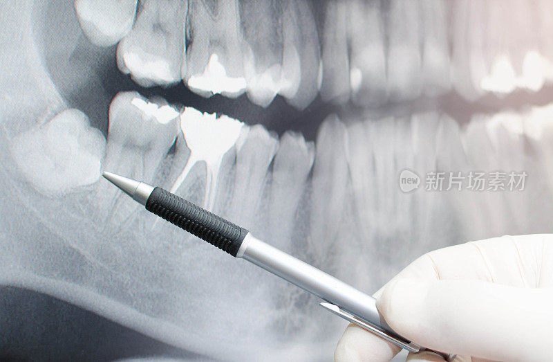 牙科医生指着牙科x光片
