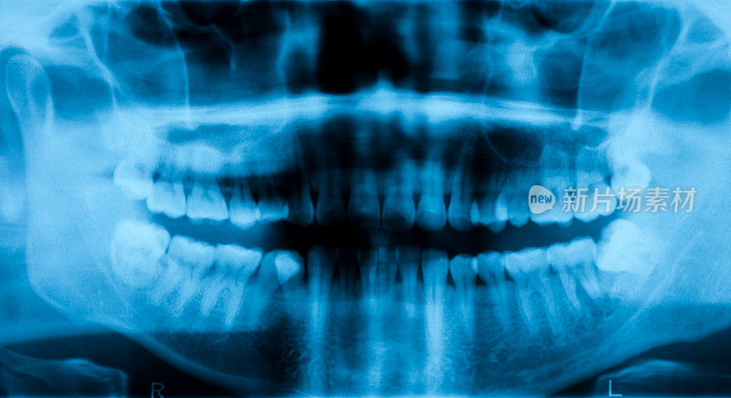 全景牙科x光图像。