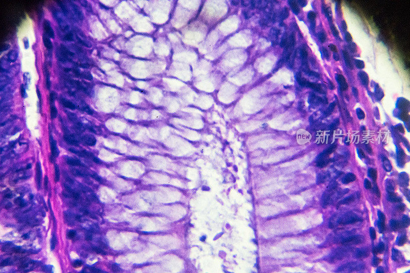 显微镜下的大肠癌(差异很大，管状腺癌)