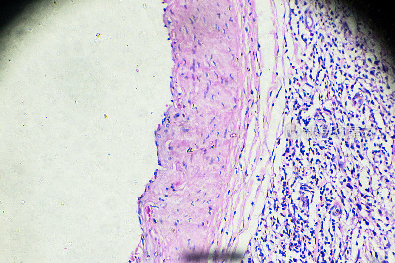 何杰金氏细胞病，淋巴瘤，显微镜下的HL