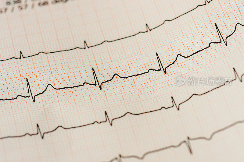 心电图(ECG)细节