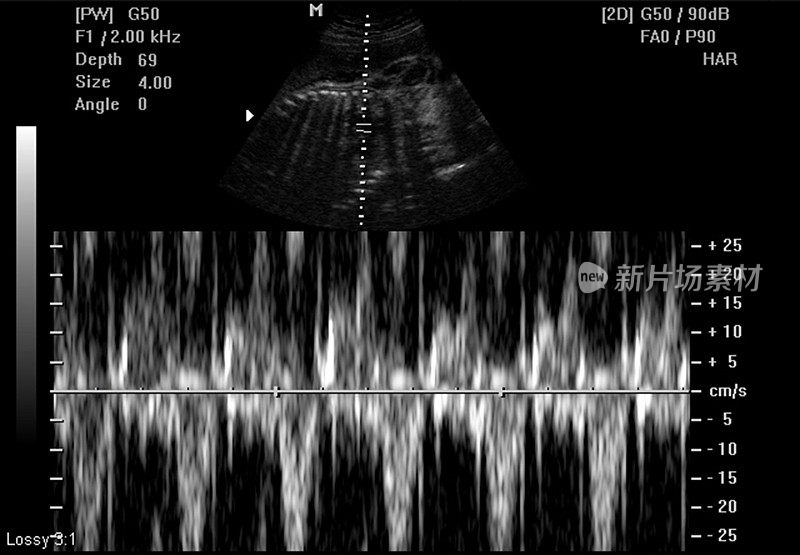 胎儿宝宝超声波屏幕截图