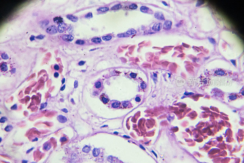 显微镜下急性肾炎活检标本