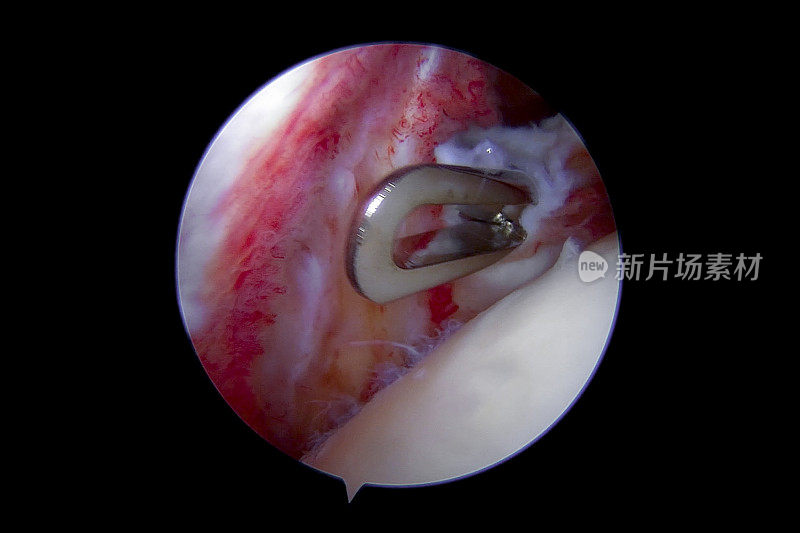 肩关节囊切开术患者使用篮击的关节镜观察