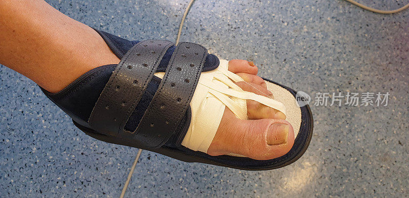 经皮足部手术后足部伤口的术后敷料及手指的平衡