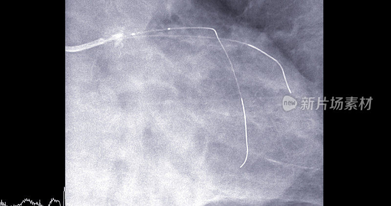 左前降支(LAD)心导管检查可以帮助医生诊断和治疗心脏和血管的问题，如心脏病发作或中风。