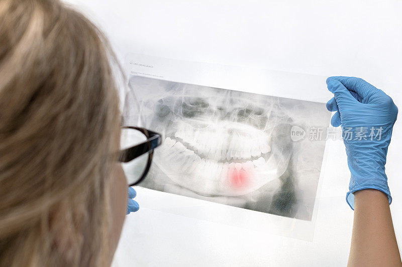 一名女牙医手里拿着病人的x光扫描图，分析有红色标记的病变牙齿的治疗和根管填充。牙科,orthopantomogram。后视图