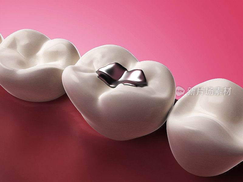 3D插图的一个银色的牙齿填补在一个磨牙