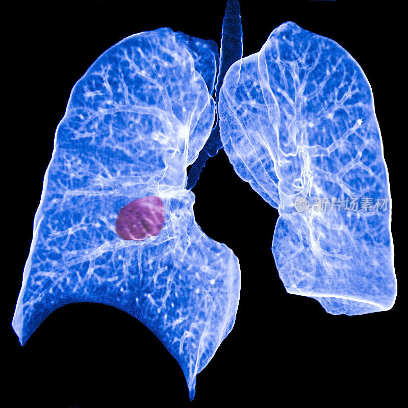 肺癌CT