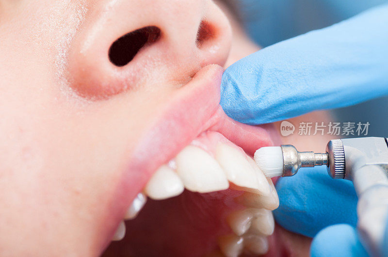 女病人在牙科诊所里刷牙齿的特写