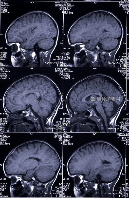 MRI脑部扫描显示头部和头骨的多个图像