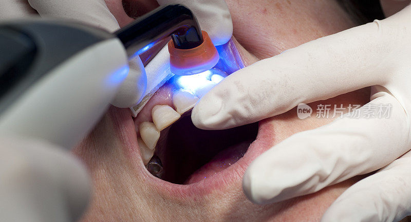 在牙科医生或完成修复时漂白牙齿