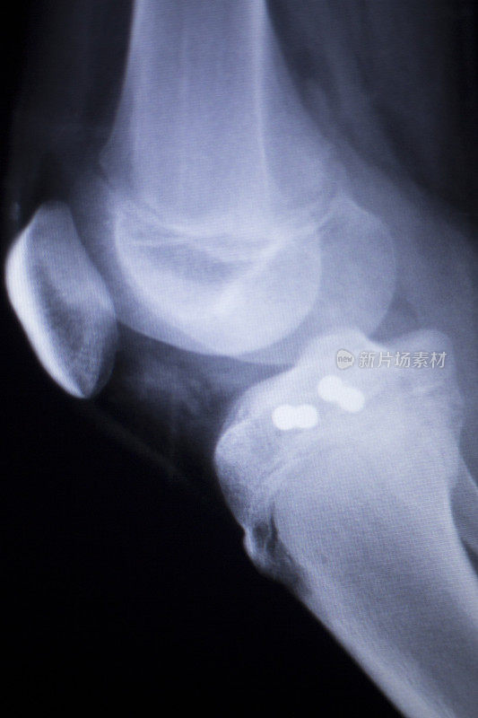 医用骨科创伤学扫描显示膝关节植入物螺钉x线。