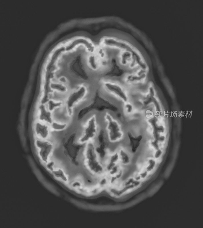 黑白医用人脑核磁共振扫描