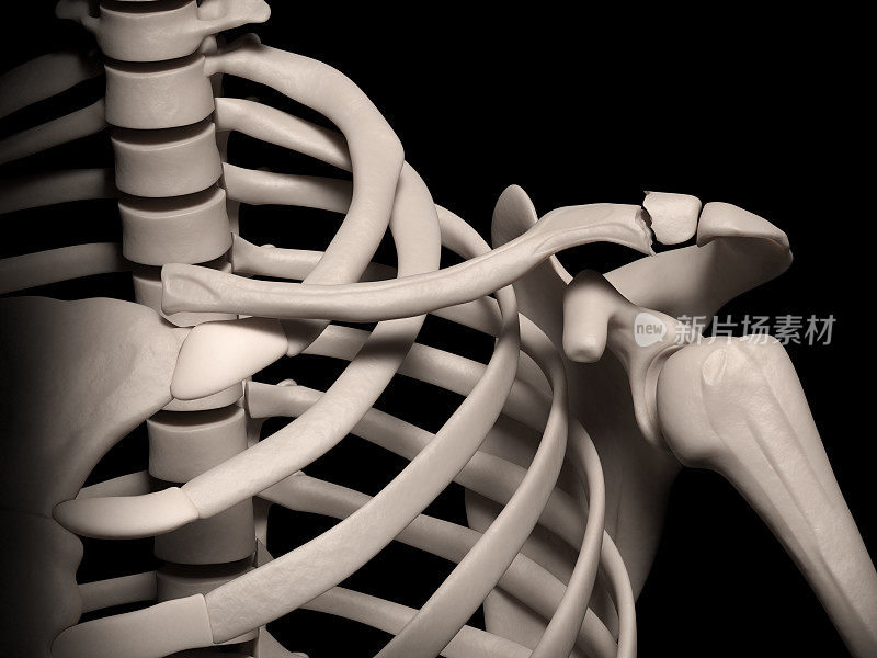 锁骨骨折-近肩胛骨