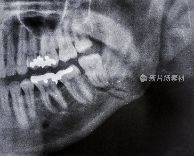 下颌骨骨折，也称为颌骨骨折，是通过下颌骨骨折。下颌骨的角度是指下颌骨主体和分支的排列所形成的角度。