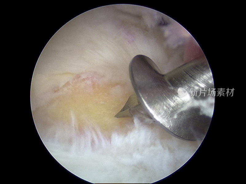 关节镜下观察钛缝合螺钉袖口修复锚