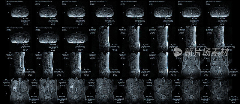 下脊柱(腰椎)MRI多视角拼接