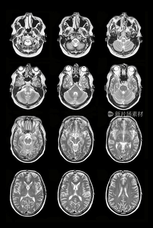 人脑磁共振断层扫描