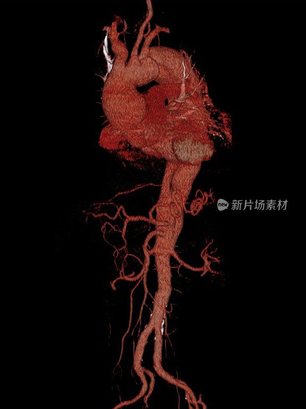 心脏和主动脉的三维计算机断层重建
