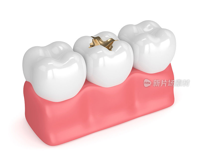 牙齿的3d渲染与牙科金填补