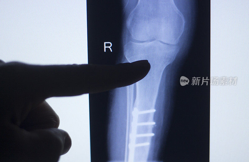 膝关节x线检查结果显示患者有关节炎和植入物膝关节疼痛。