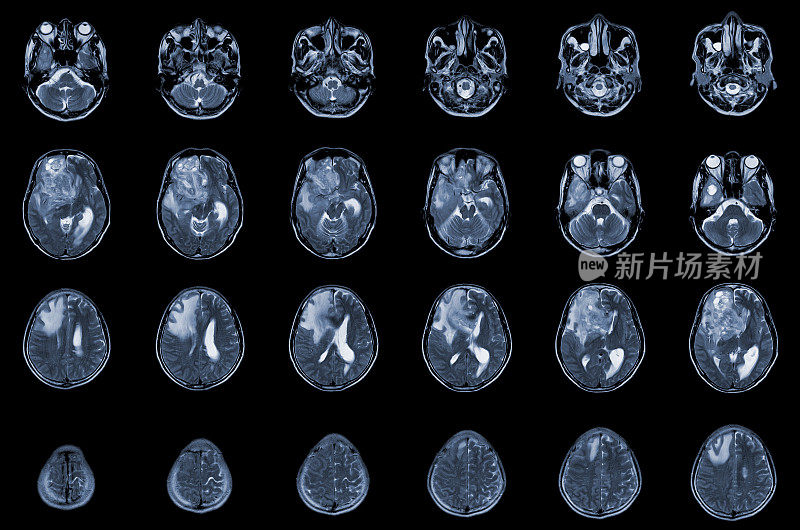 MRI脑轴位图用于评价脑肿瘤。恶性胶质瘤，脑转移等密度肿块，边缘不清，右额叶周围水肿。
