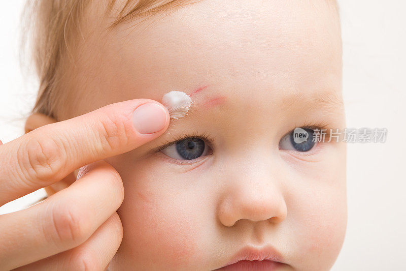 母亲用手指将白色药膏涂抹在婴儿额头擦伤的皮肤上。孤立在浅灰色背景。孩子摔倒后的治疗。特写镜头。