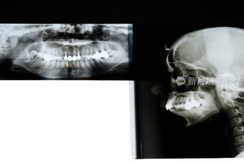 人类头骨x光片和牙科x光片，白色背景