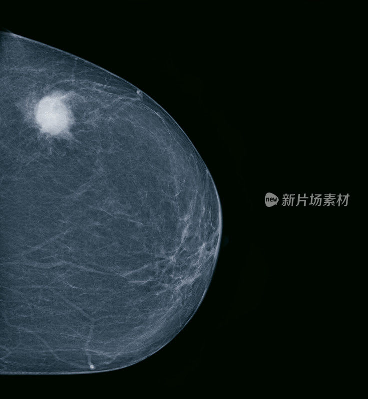 乳房x光检查中的乳腺癌