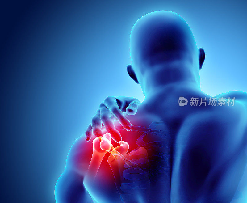 肩部疼痛的骨骼x光，3D插图。