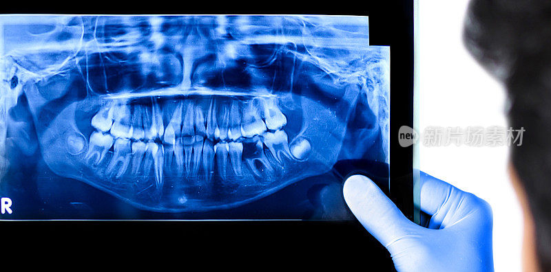 牙医拿着病人的口腔x光片
