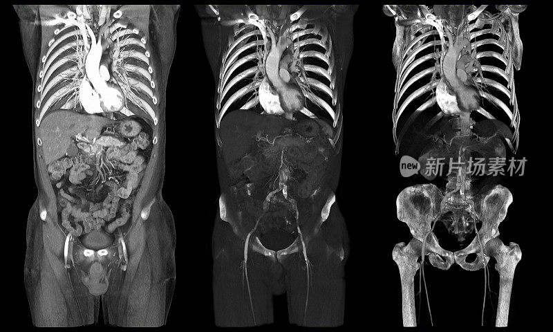内部器官的CT扫描