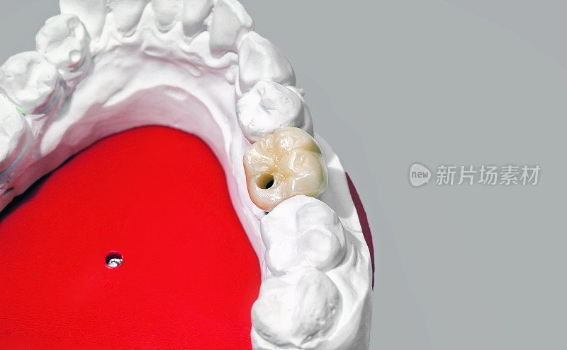 石膏牙科模型与陶瓷牙