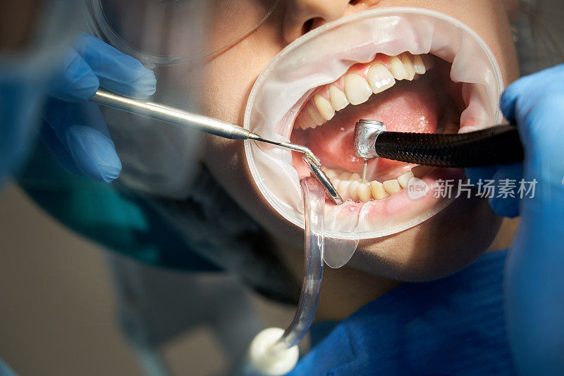 牙医在牙科椅上给男病人钻孔