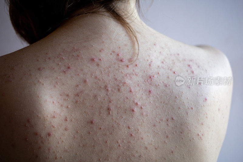 女人背部有痤疮、红斑、皮肤病