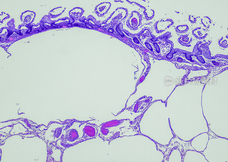 积气囊状的intestinalis。摘要肠囊病(PCI)是一种罕见的疾病，其特征是肠壁存在含有氮、氢和二氧化碳的气态囊肿，可能是医源性或与之相关