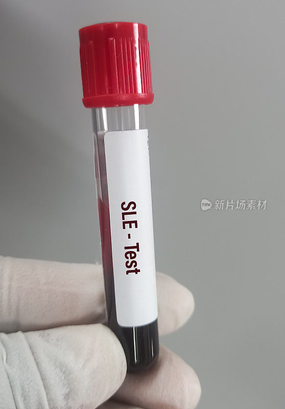 血液样本用于系统性红斑狼疮(SLE)检测诊断自身免疫性疾病。