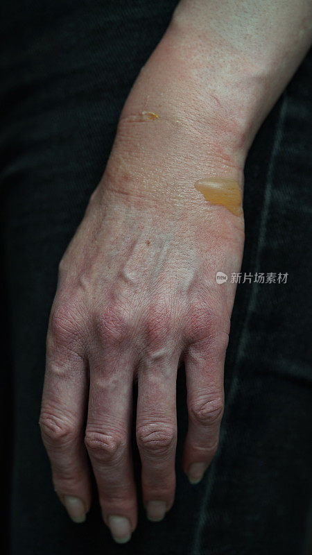 近距离的一个女人的手与水泡从开水烧伤，受损的皮肤，一级或二级烧伤。痛苦的伤口。热灼伤。烧伤后膀胱积水，治疗伤口。宏观照片