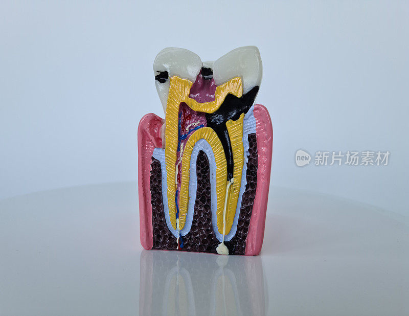 有龋齿的牙齿和牙颌模型