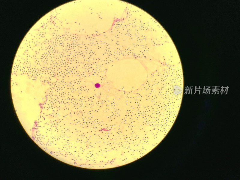 显微镜观察显示肺炎球菌性脑膜炎
