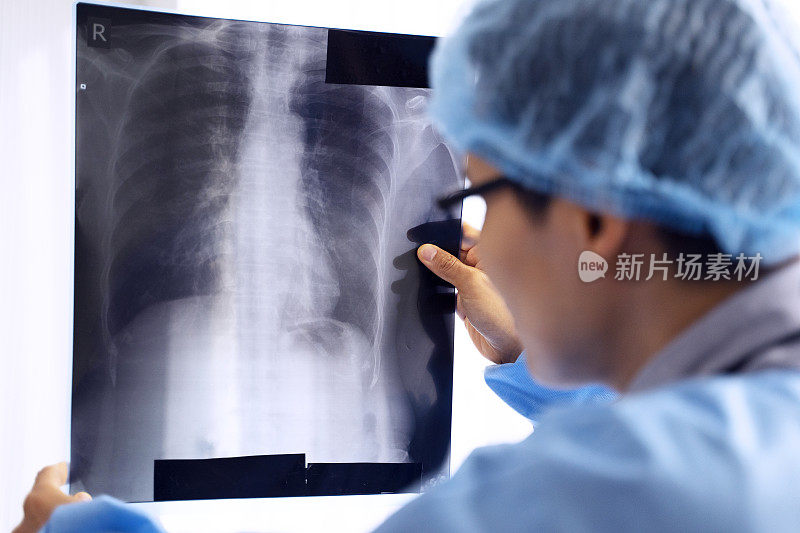 医生在医院看了病人的肺部x光片