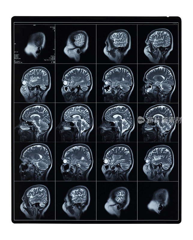 MRI头部扫描侧视图