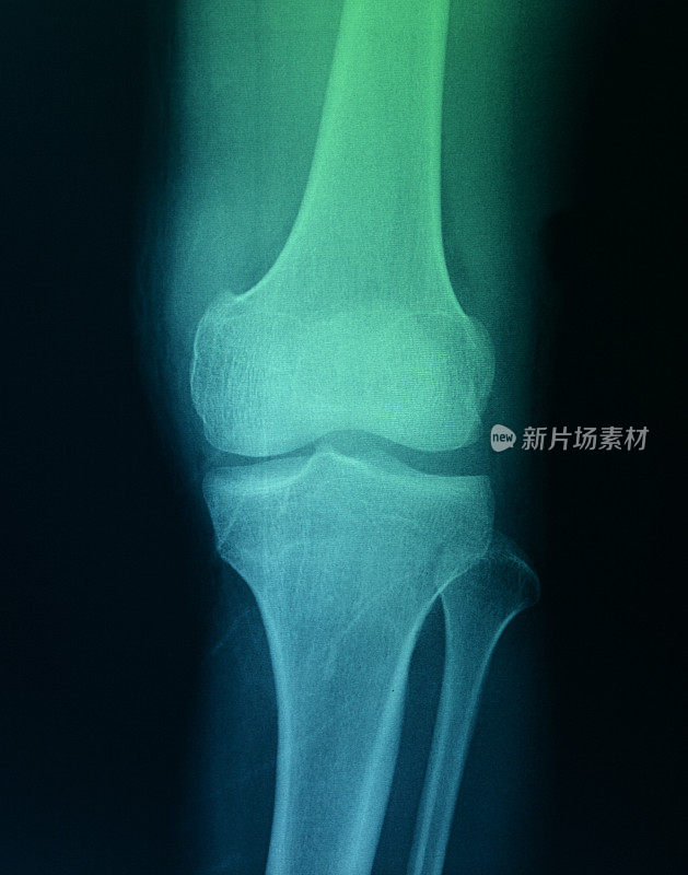 膝关节x光骨人类腿部解剖学